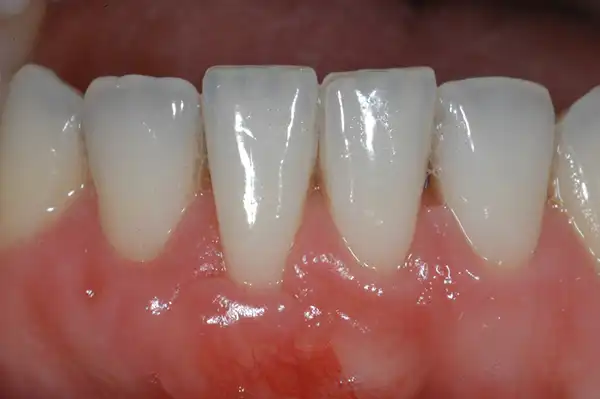 Gum graft after