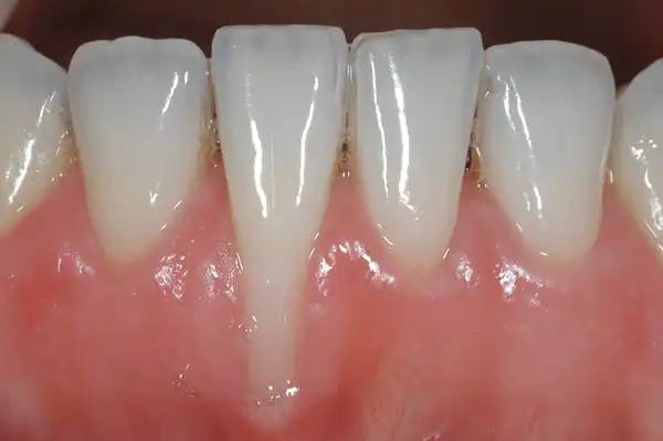 Gum graft before