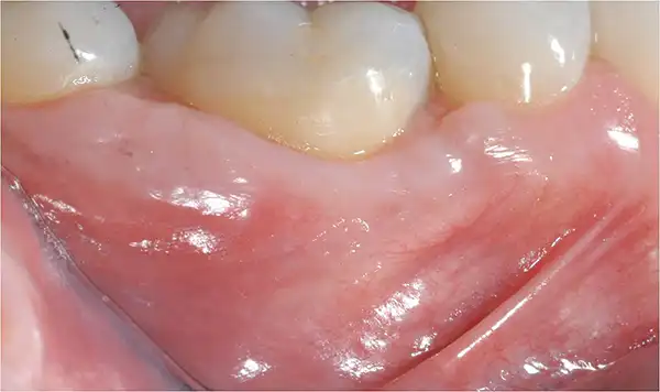 Gum graft after