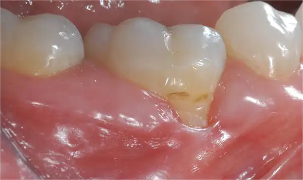 Gum graft before