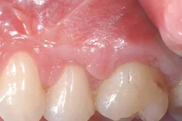 Gum graft after