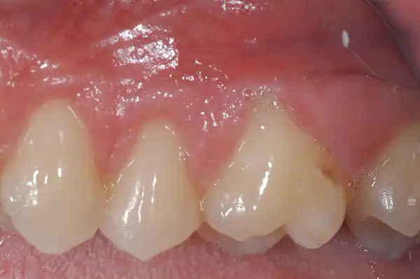 Gum graft before