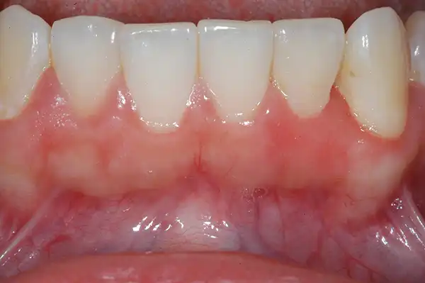 Gummy smile after
