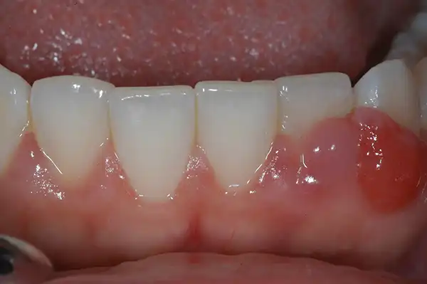 Gummy smile before