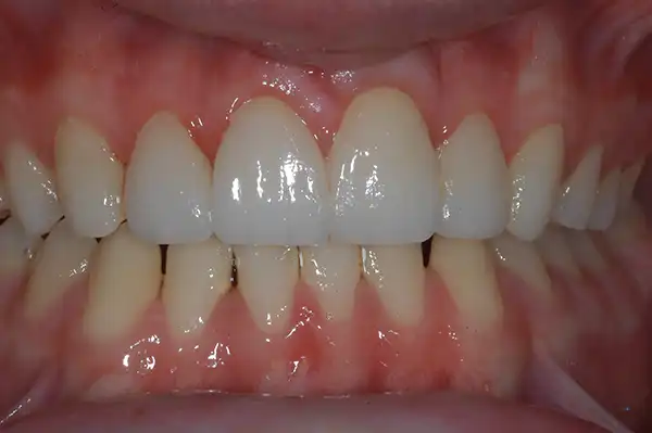 Gummy smile after