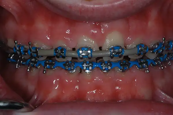 Gummy smile before