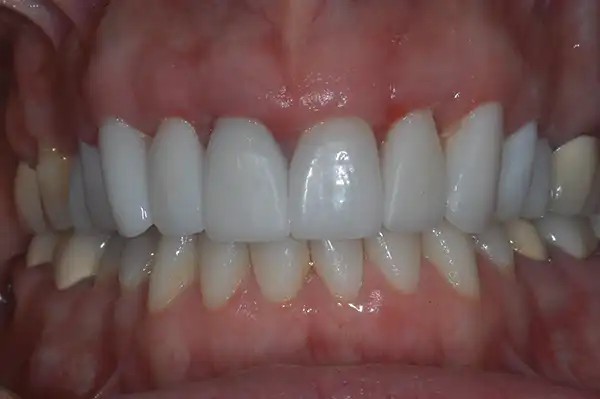 Gummy smile after