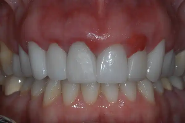Gummy smile before