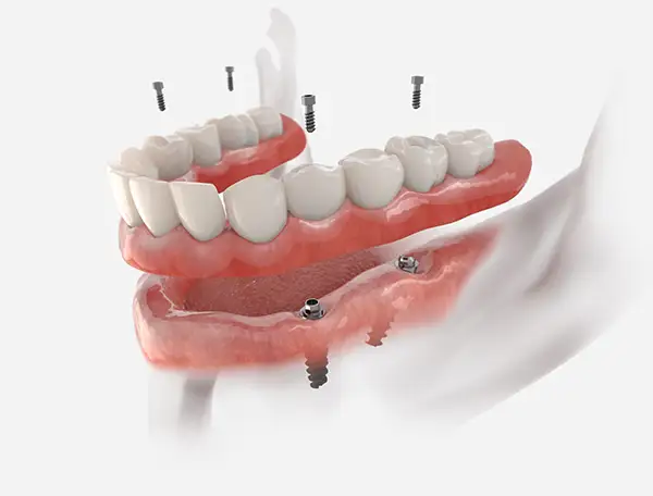 Lower jaw teeth restoration with All on 4 implants