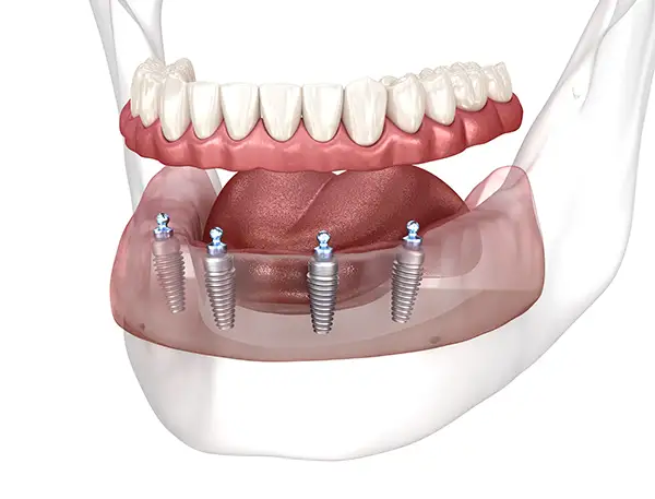 Mandibular prosthesis supported by All on 4 implants system