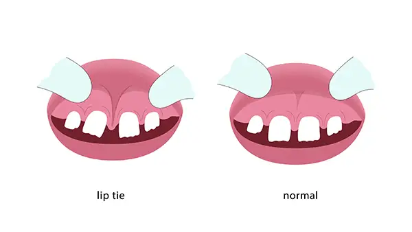 A drawing showing a the before and after of a lip tie procedure 