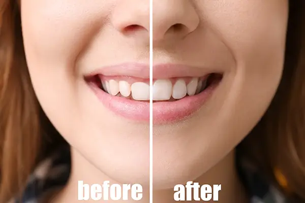 A before and after of a woman's smile after gingival contouring.