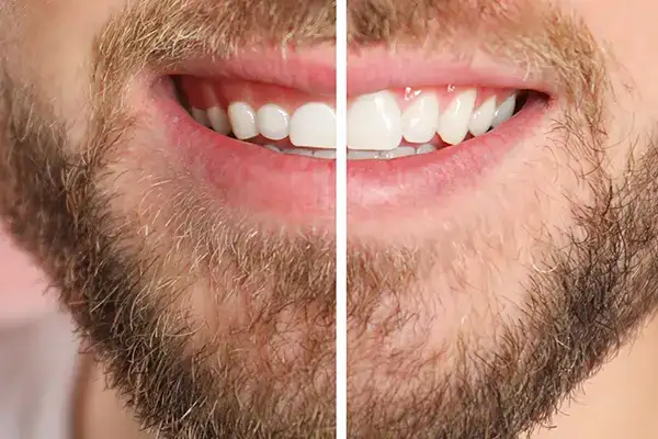 Before and after comparison of a man's smile, highlighting enhanced gum shape and balanced teeth after gingival contouring.