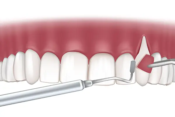 Tissue graft being placed on a portion of the tooth with dental tools.