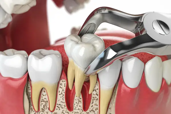 Rendering of a tooth being pulled out from a row of teeth
